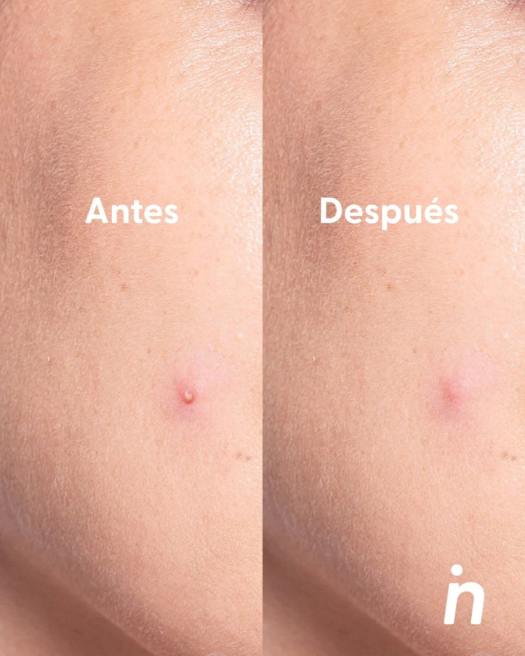 PARCHE PARA GRANOS USO DÍA NIPSKIN